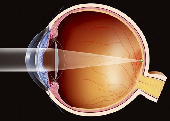 La cataracte : Un problème optique
