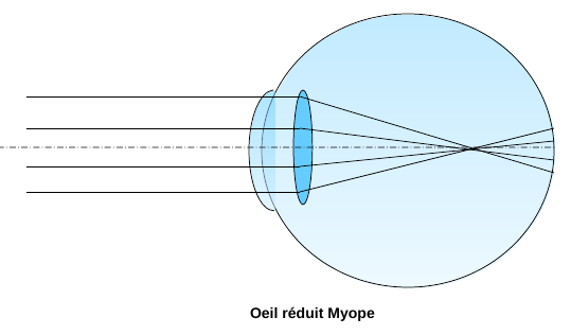 image d'un oeil myope nécessitant des lunettes