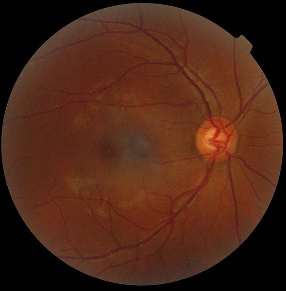 image de la rétine d'un oeil sur lequel on peut utiliser des lunettes